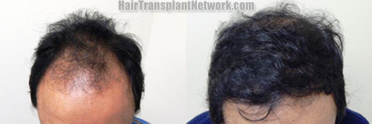 hair-restoration-top-177665.jpg