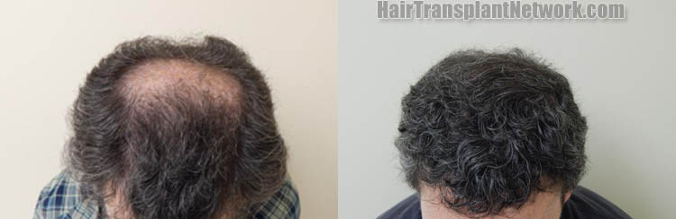 hair-restororation-procedure-top-181156.jpg