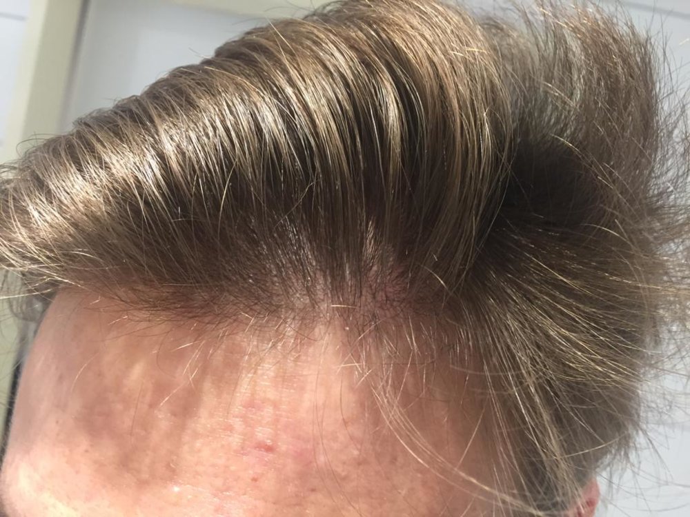 hair thin.jpeg