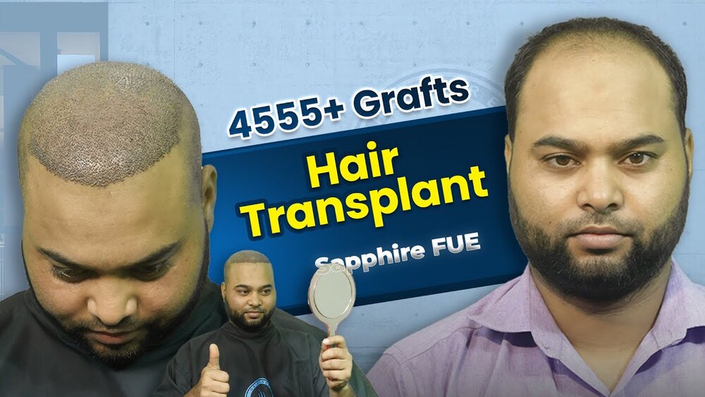 Hair Transplant Journey of Jahir Raihan.jpg