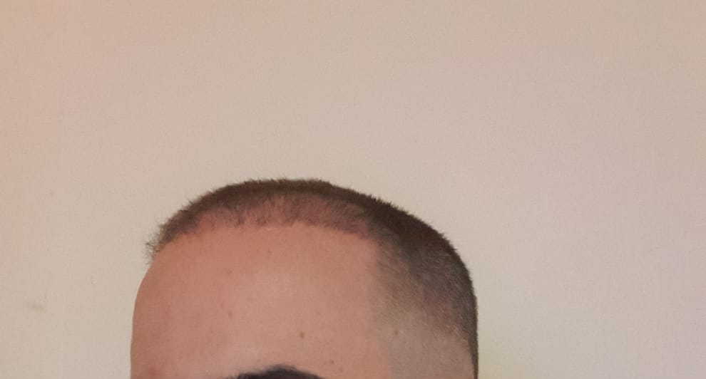 hair transplant.jpeg