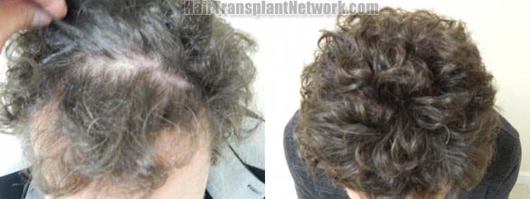 hair-transplant-photos-top-178738.jpg