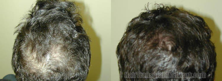 hair-transplant-surgery-crown-166314.jpg