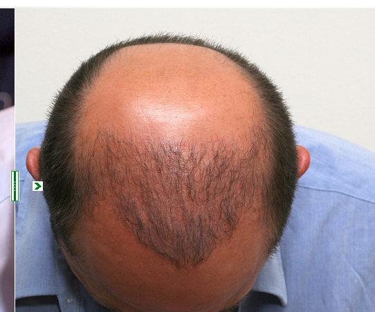 hair transplant thin.png