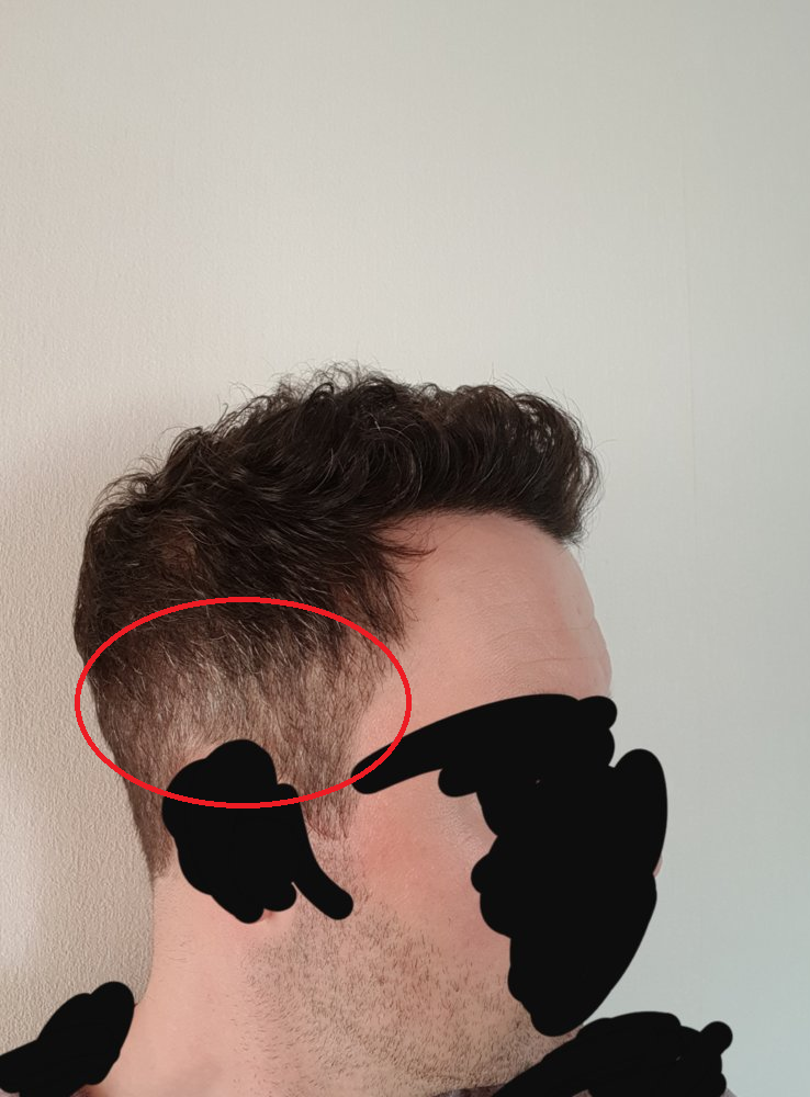 hair transplant thin sides.png