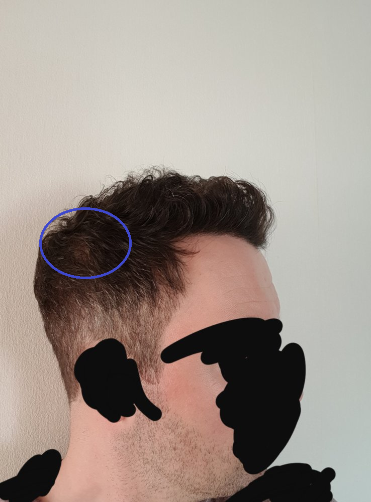 hair transplant thin sides.png