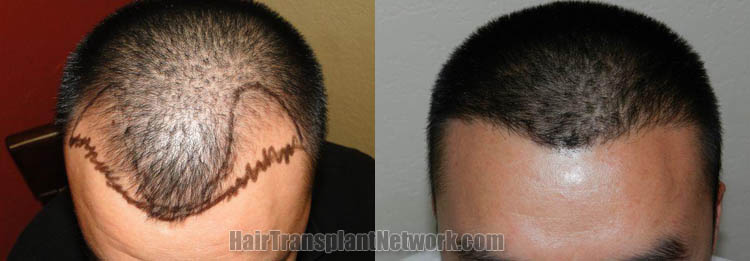 hair-transplant-top-167806.jpg