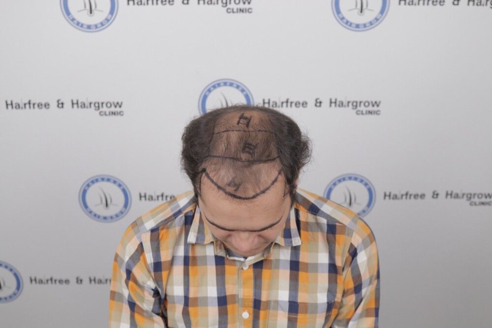 hairline marking.JPG