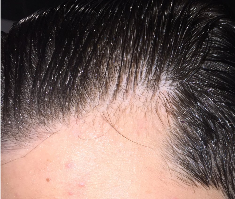 Dermarolling Success - 2 Months In Pictures Attached | HairLossTalk Forums