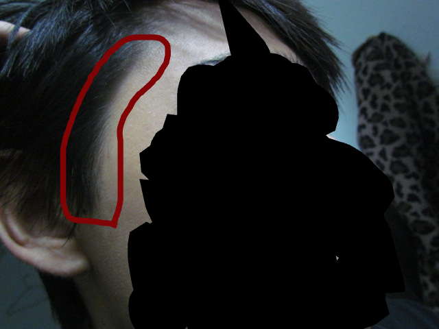 hairloss version 2.jpg