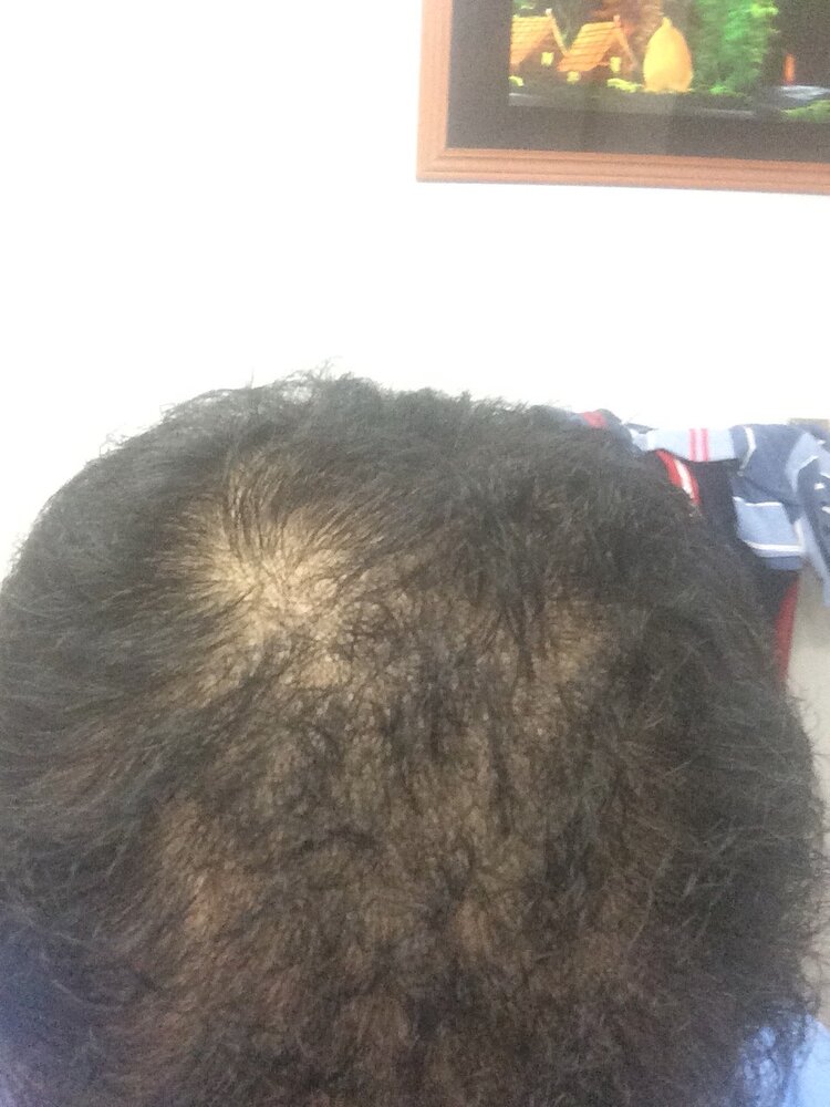 hairloss2.jpg