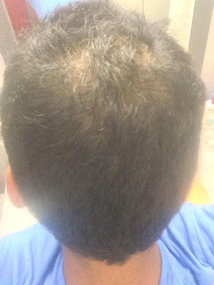 hairloss3.jpg