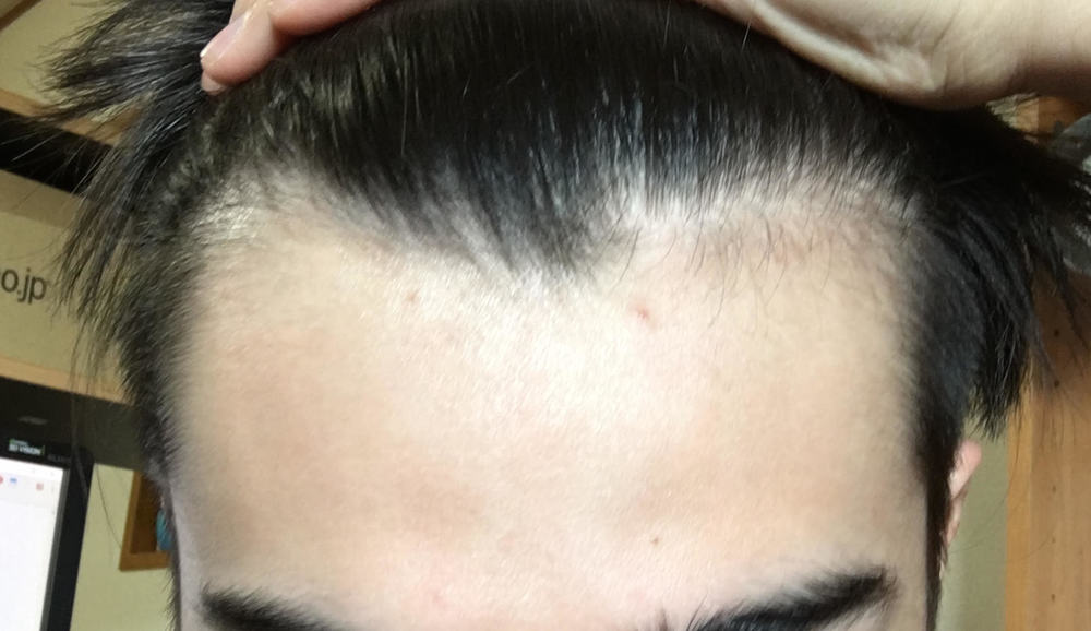 18,male, Early Signs Of Balding, What Can I Do? | HairLossTalk Forums