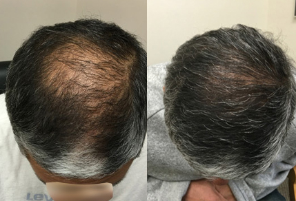 hs-post-op-3000-graft-FUE-in-a-50-year-old-male-FI.jpg