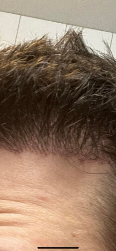 Low density hair transplant (Month 13). Help me make the right decision! |  HairLossTalk Forums