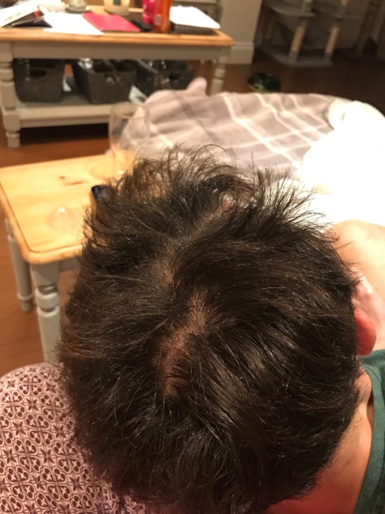 Thinning Crown Or Normal Crown? Please Advise | HairLossTalk Forums