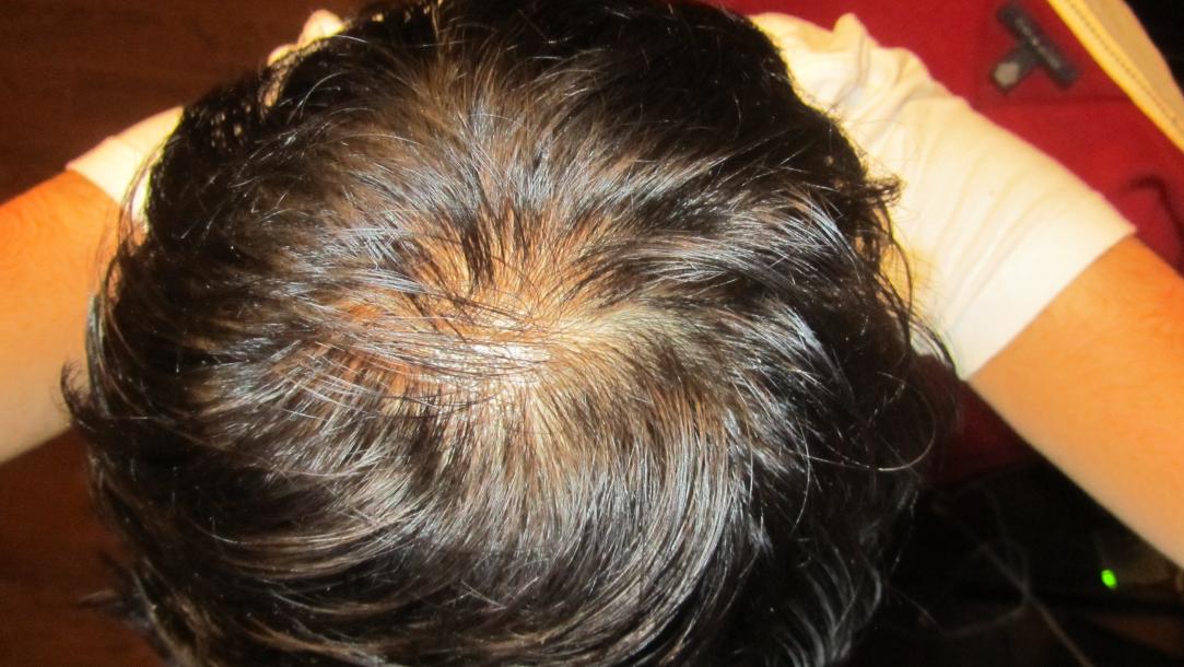 I'm 19 - My Crown Looks Very Thin | HairLossTalk Forums