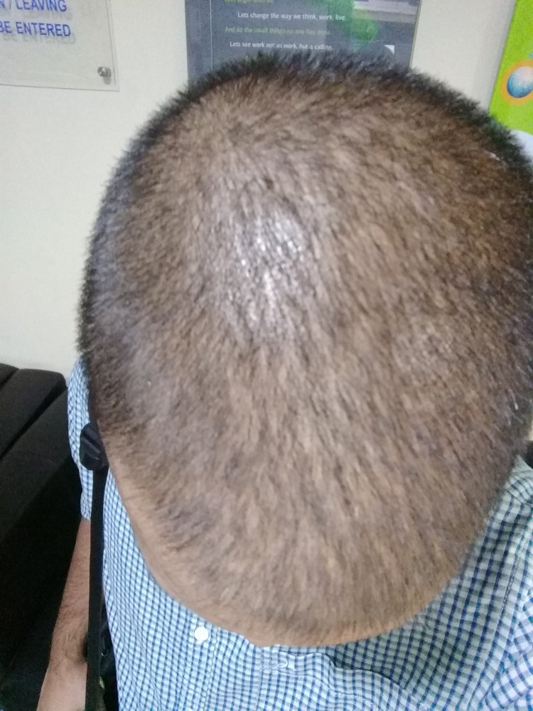 Fine Hair Or Diffuse Thinning/ Male Pattern Baldness? | HairLossTalk Forums