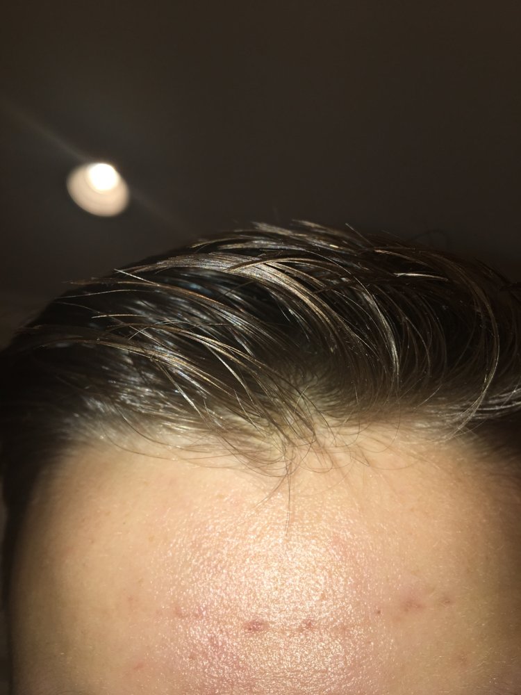 16 Years Old. Is My Hairline Receding? Please Help | HairLossTalk Forums