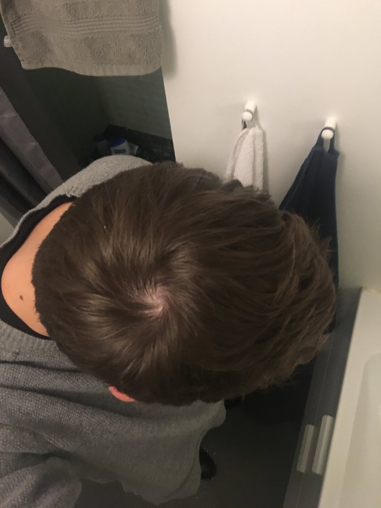 Is This Early Stages Of Male Pattern Baldness? | HairLossTalk Forums