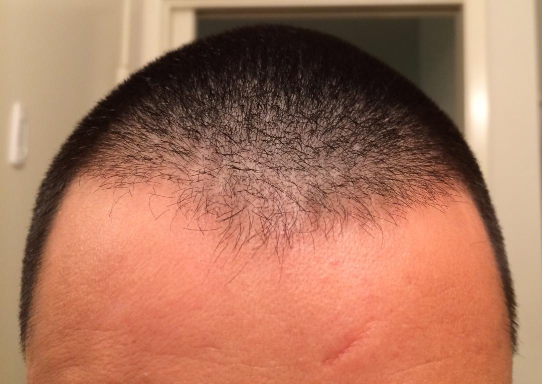 Is This Diffuse Thinning Problems With Thyroid HairLossTalk