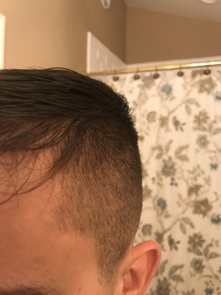 Is The Left Front Side Of My Hair Thinning? | HairLossTalk Forums