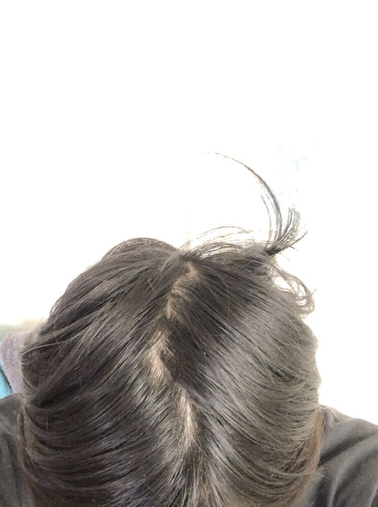 23 y/o asian male, ca't tell if my hair on crown is thinning/shedding and  if hairline is receding/maturing | HairLossTalk Forums