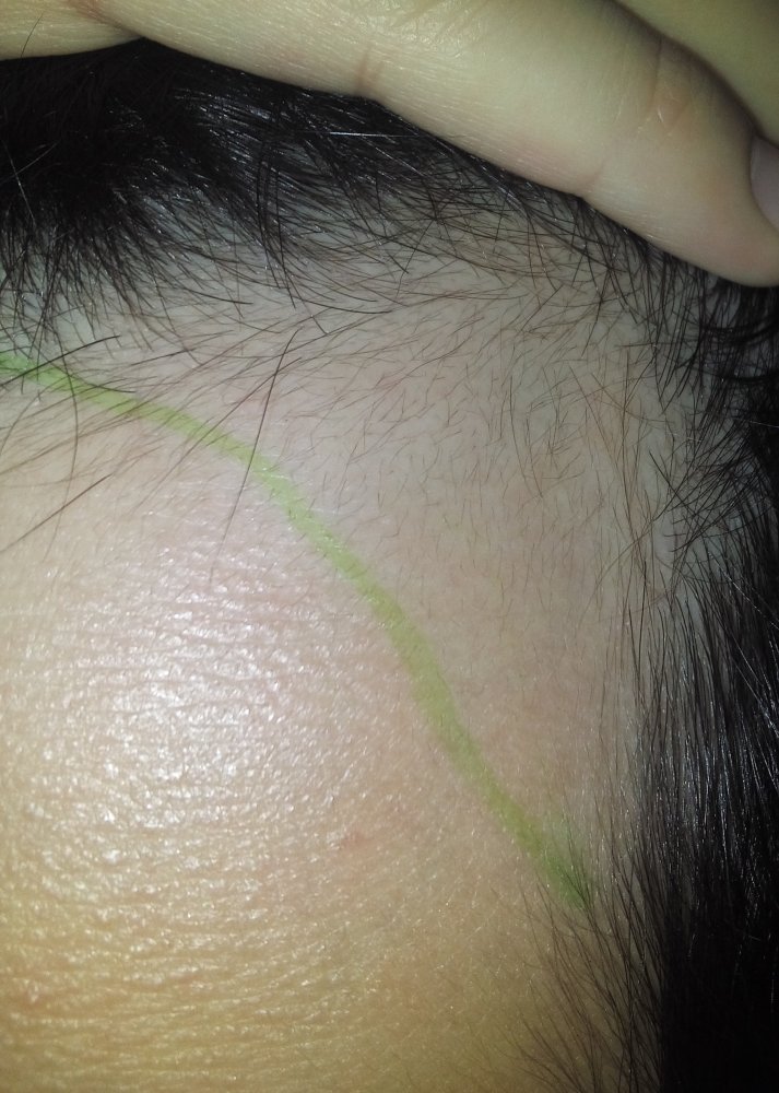 Miniaturized Hair Or Regrowth Can You Tell Hairlosstalk Forums