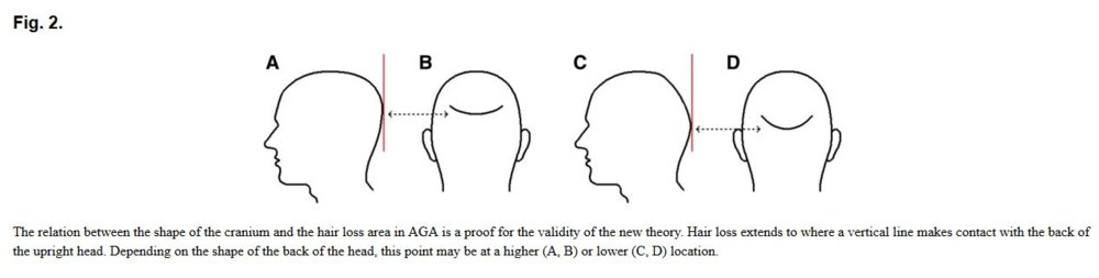 IMP forma craneo y apoyo almohada y calvicie.JPG
