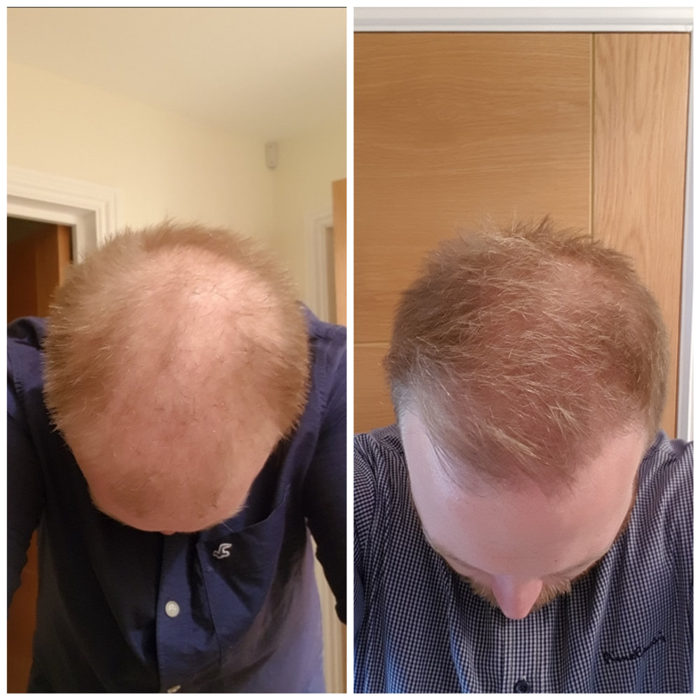 finasteride 8 months no results
