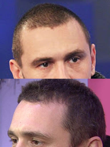 james-franco-buzz-cut-hair-loss.jpg