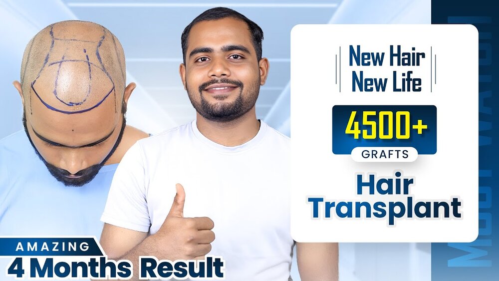 Karan Sahu's Incredible Hair Transformation at Hairfree & Hairgrow, Bhopal.jpeg