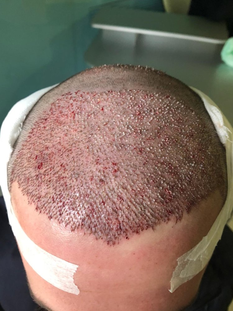 klinik ekim sonrasıön.jpg