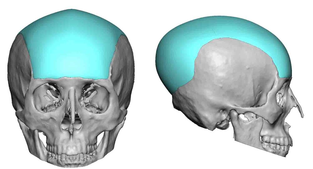 Large-Custom-Skull-Implant-design-Dr-Barry-Eppley-Indianapolis.jpg