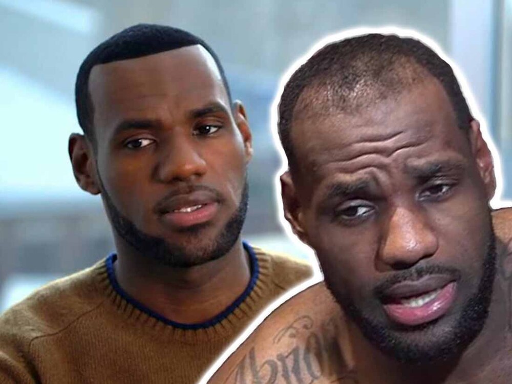 lebron-james-hair-transplantation.jpg