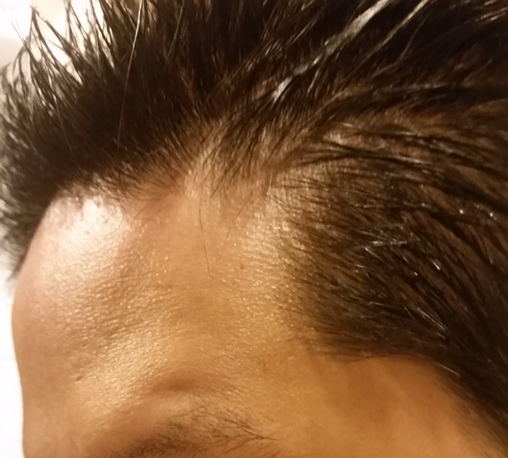 Plz Look At My Left Temple Hairline: male pattern baldness Or Not?  Diet-related? [photos] | HairLossTalk Forums