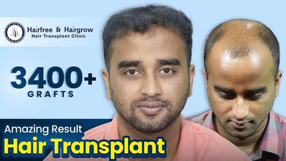 Mahmudur Rahman Sourav’s Hair Transplant Journey with Hair Free & Hair Grow, Bangladesh.jpg