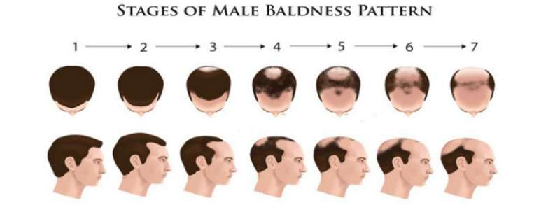 male-baldness-stages.jpg