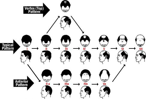 male-hair-loss-classification.jpg