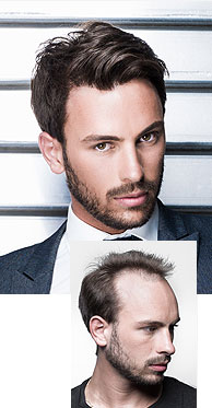 male-pattern-baldness.jpg