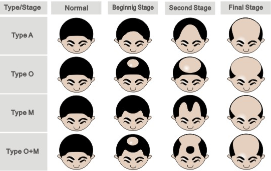 Male-Pattern-Baldness.png