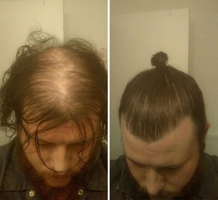 man-bun-hide-baldness-1-59199d988a20b__700.jpg