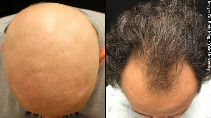 Man-With-Alopecia-Totalis-Regrows-Hair-Finds-He-Has-Receding-Hairline.jpg