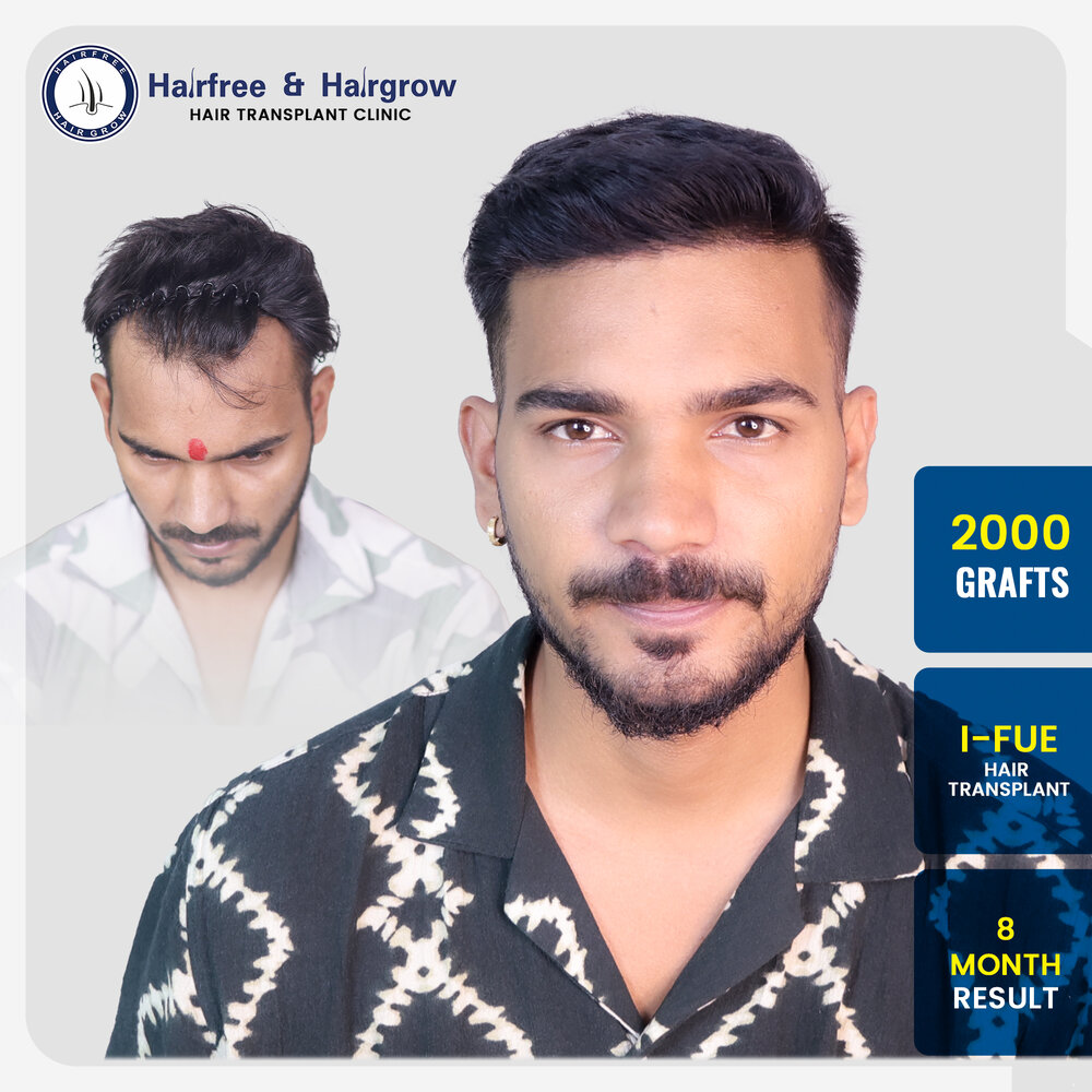 manish-2000-grafts-i-fue-hair-transplant-8-month-result-pune.jpg.jpg