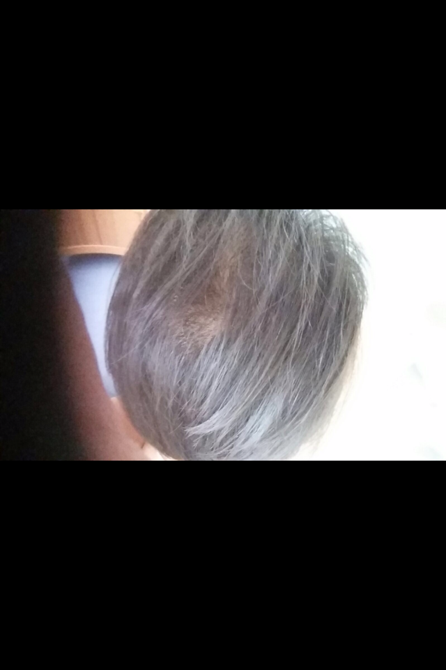 manisha hairloss growth.png