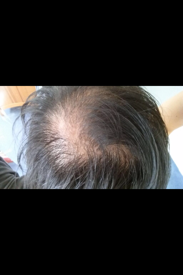 manisha hairloss.png