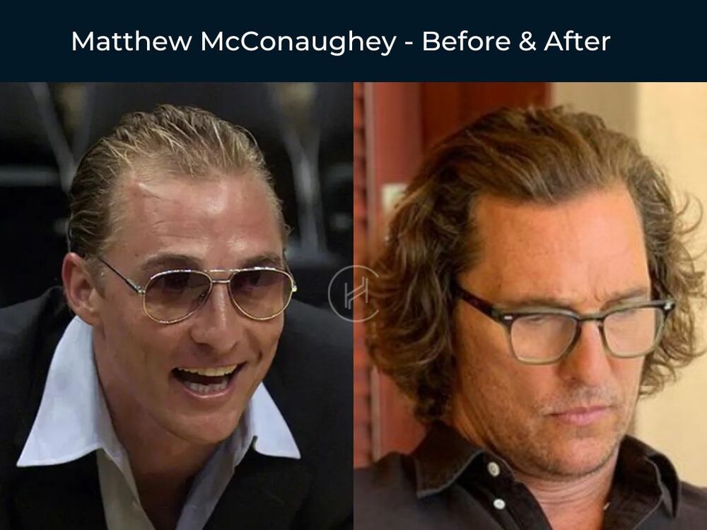 Matthew-McConaughey-Hair-Transplant-Before-After.jpg