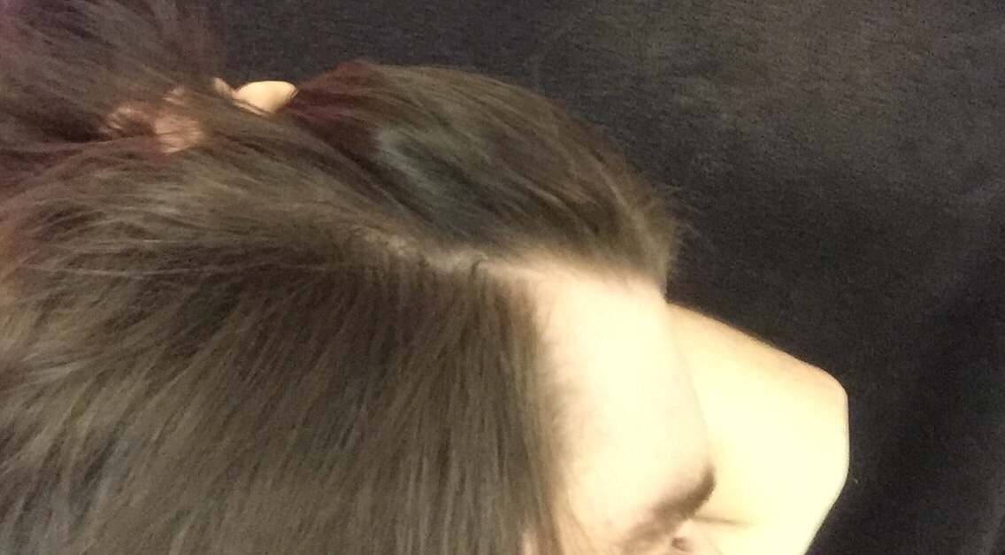 Is my crown thinning? Or is this just a cowlick? | HairLossTalk Forums