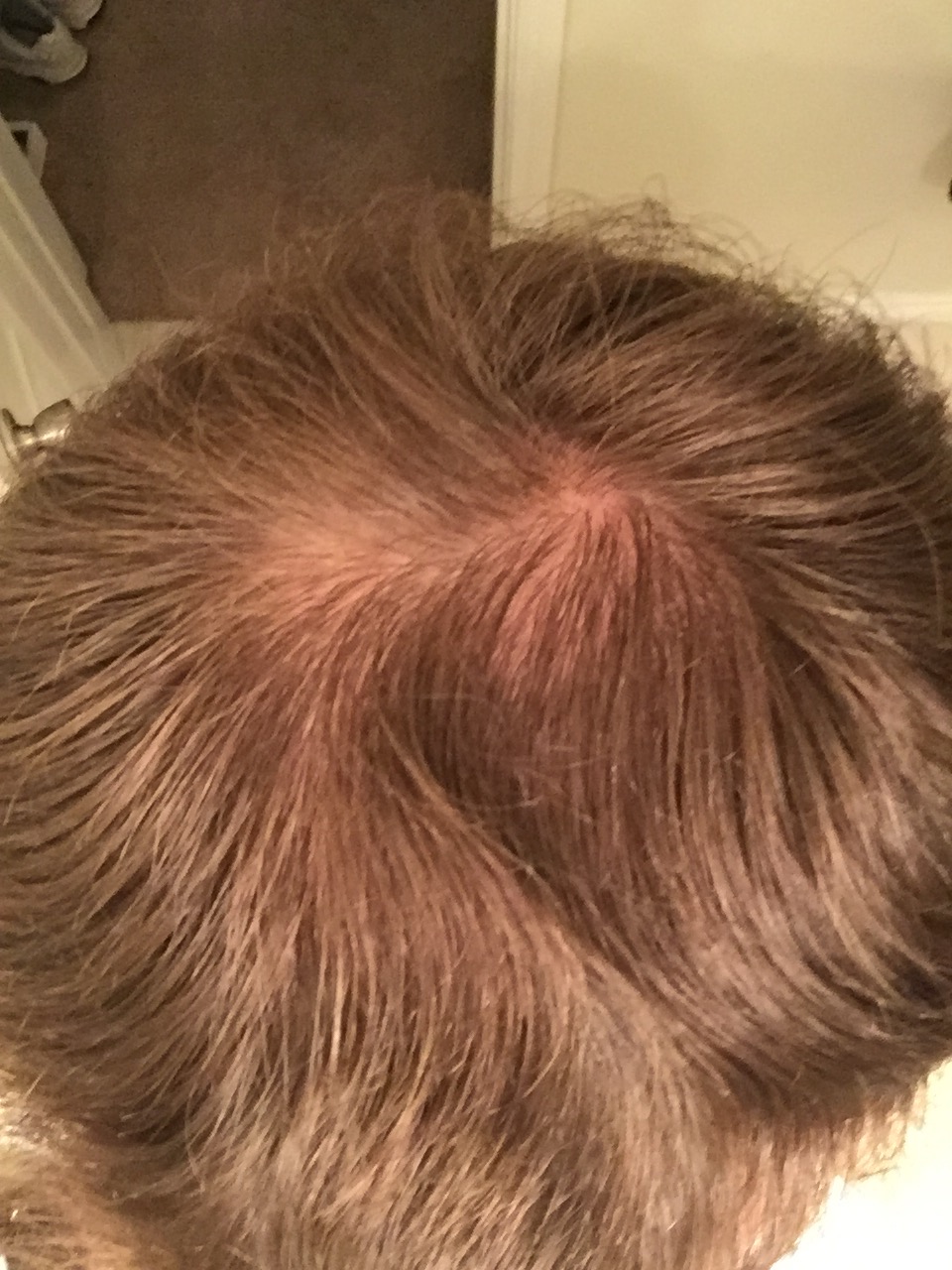 21 and mild hair loss | HairLossTalk Forums
