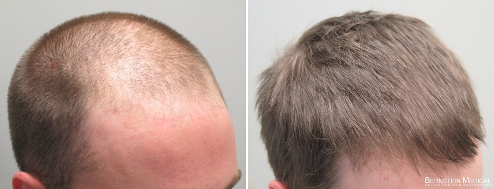1 month finasteride results